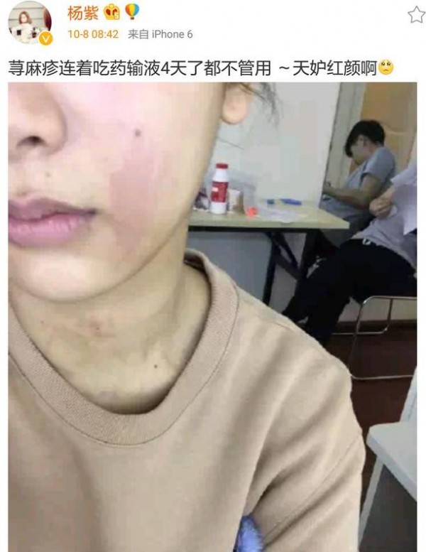 马思纯患带状疱疹是什么情况?